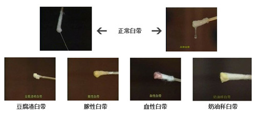 白带异常都有哪些症状表现