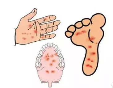 预防手足口病手抄报_如何预防手足口病